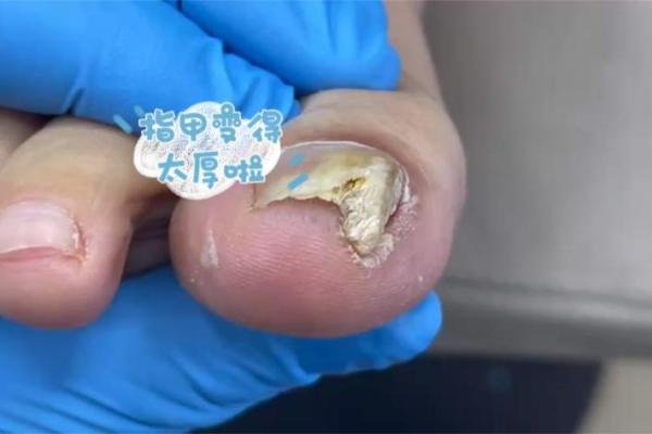 男人水指甲的命运解析：指甲背后的秘密与影响