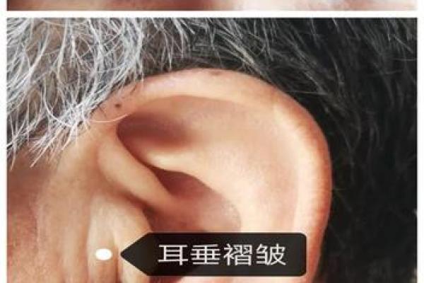 男人没有耳垂的命运解析：耳垂何以影响人生轨迹？