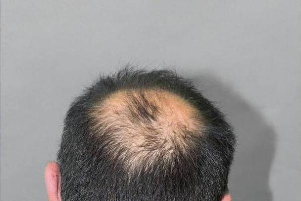 中年秃头的命格与人生哲学探讨：智慧与魅力的别样体现