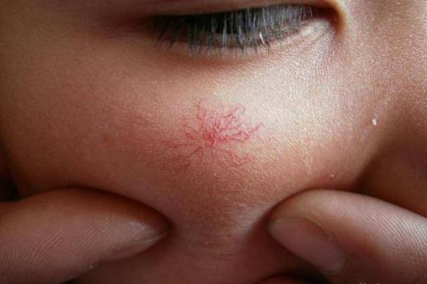 探秘后背长红痣的命运象征与意义