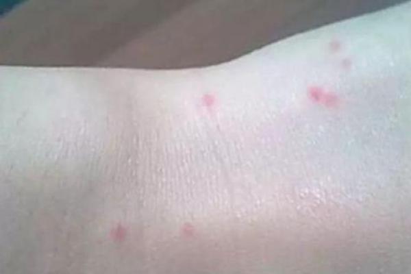 探秘后背长红痣的命运象征与意义 探秘后背长红痣的命运象征与意义