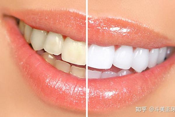 了解牙相:下牙包上牙的命运之谜与运势解析 了解牙相:下牙包上牙的命运之谜与运势解析