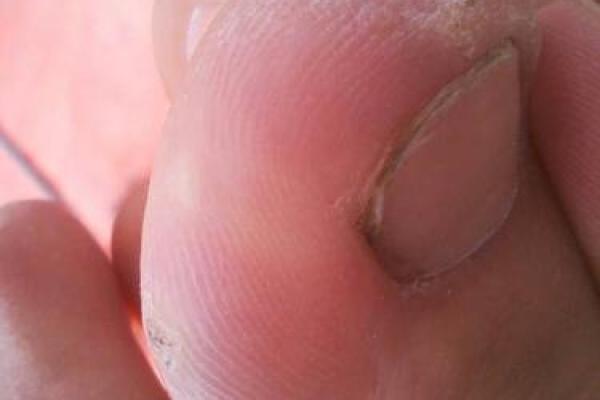 脚拇指肥大是什么原因？解析下肢健康如何影响生活质量！