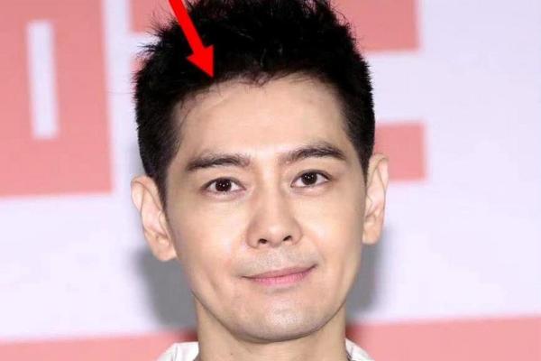 额头凹陷疤痕暗示的命运：了解它的深层含义与影响