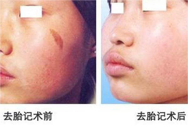 头顶长胎记的人,命运何其不同?探秘胎记的奥秘与缘分 头顶长胎记的人,命运何其不同?探秘胎记的奥秘与缘分