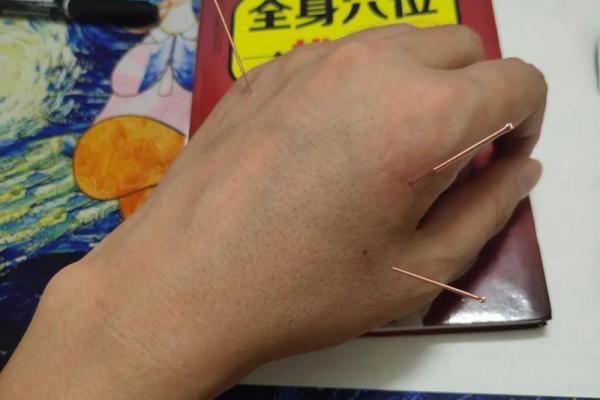 适合针灸的人群与针灸的神奇疗效探秘