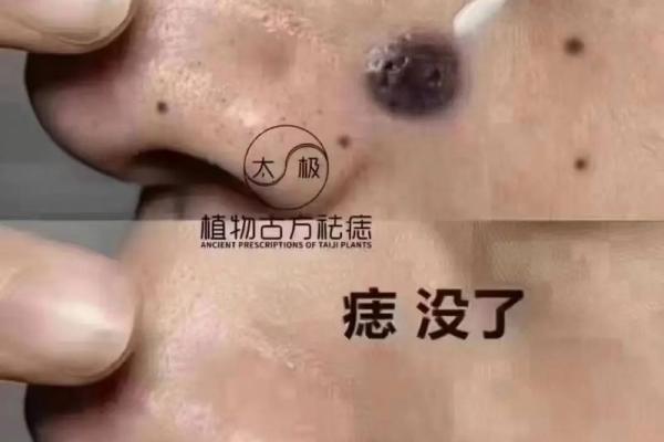 揭秘：鼻子下面长瘊子的命运解析与心理影响