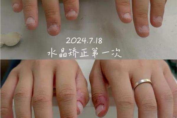 探秘指甲肉包甲的命运，揭示生活中的微妙关系