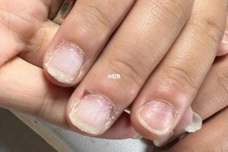 探秘指甲肉包甲的命运，揭示生活中的微妙关系