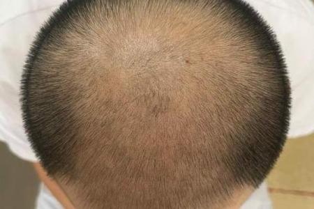 佛教智慧：揭示男人秃顶的命运与内心的真实