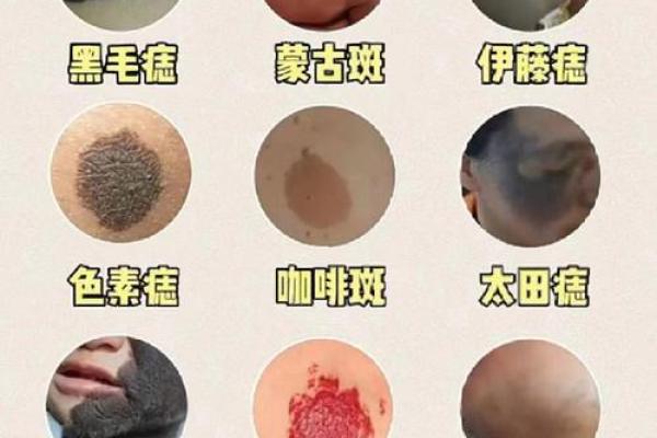 探索胎记与痣：命理背后的神秘含义与人生影响