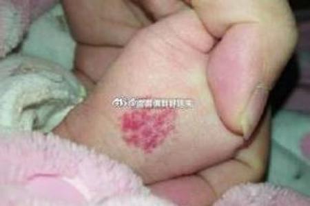 带胎记的人命运如何？探索胎记与个性命运的神秘关系