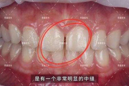 面相学揭秘：牙缝大小影响命运的深层次解析