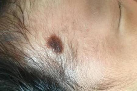 腋下胎记的神秘寓意：揭示潜藏在你命运中的秘密
