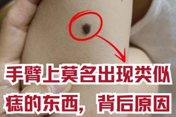 探秘：肩上有痦子究竟暗示着什么样的命运与人生之路？