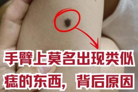 探秘：肩上有痦子究竟暗示着什么样的命运与人生之路？