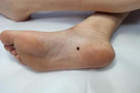 脚旁边突起的秘密：它暗示着你的命运走向