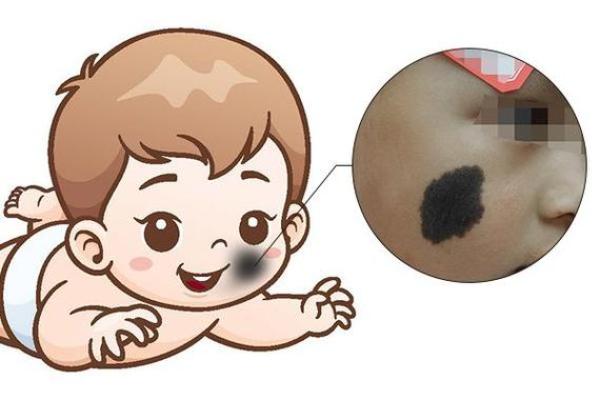 臀部胎记的命运解析：它们隐含的秘密与未来的指引